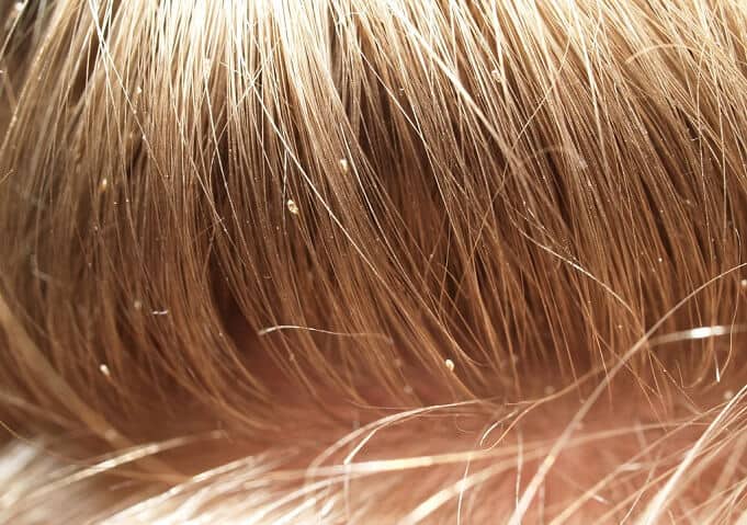 Licenders: Lice Removal Salons, Treatment and Products