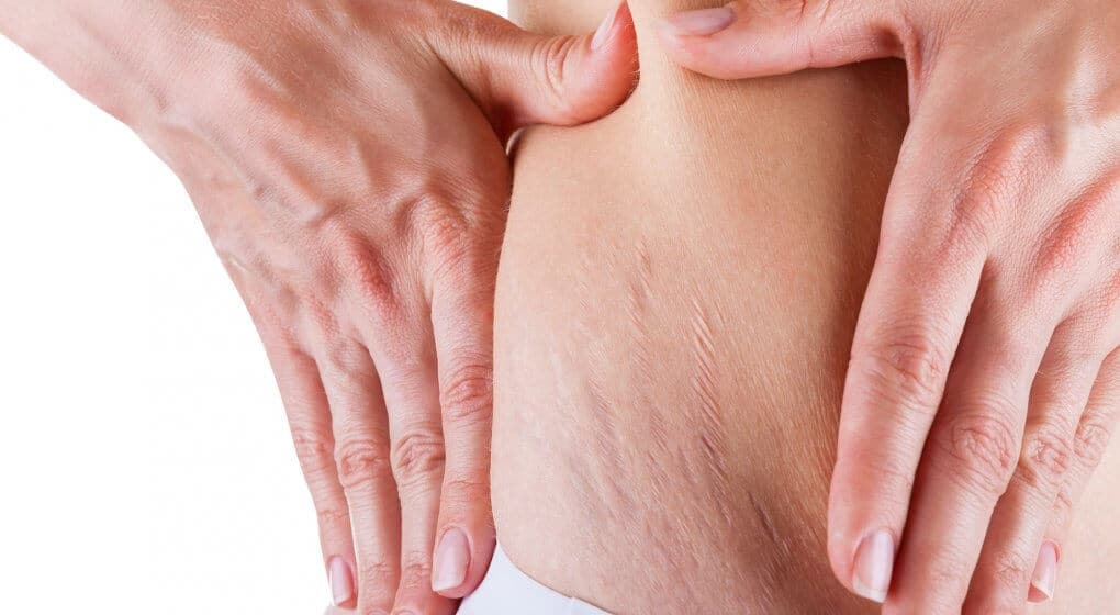 home remedies for stretch marks
