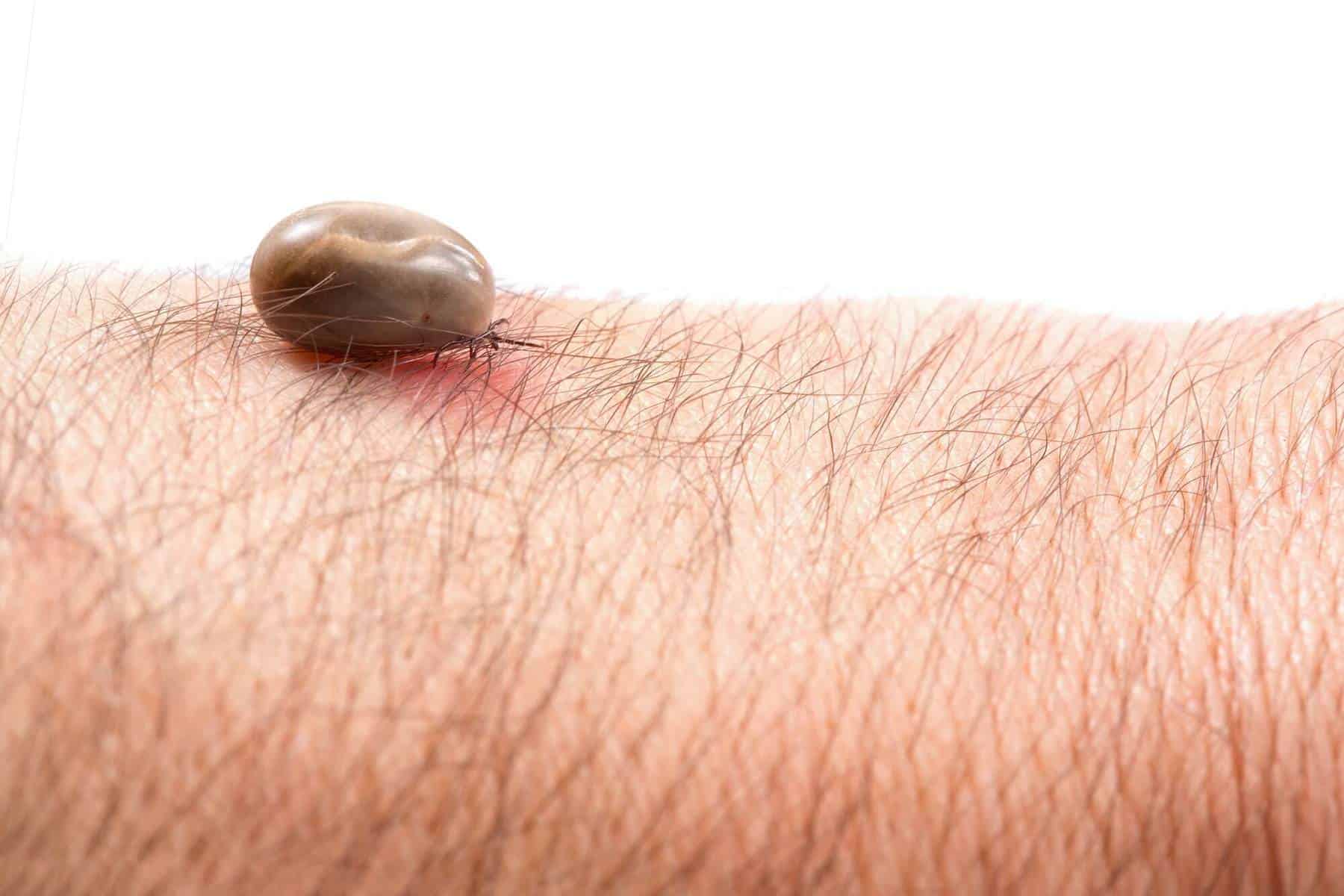 Tick bite - Lyme Disease